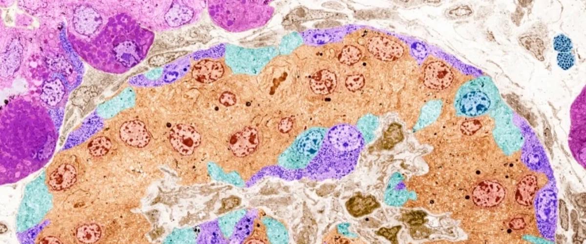 Ученые впервые пересадили пациенту с диабетом отредактированные CRISPR клетки Ученые впервые пересадили пациенту с диабетом отредактированные CRISPR клетки